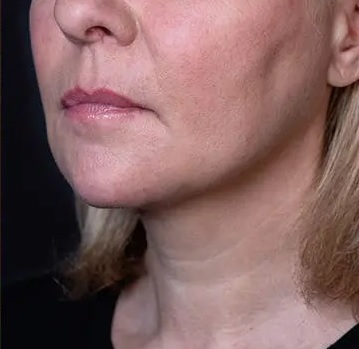 După tratament - profil